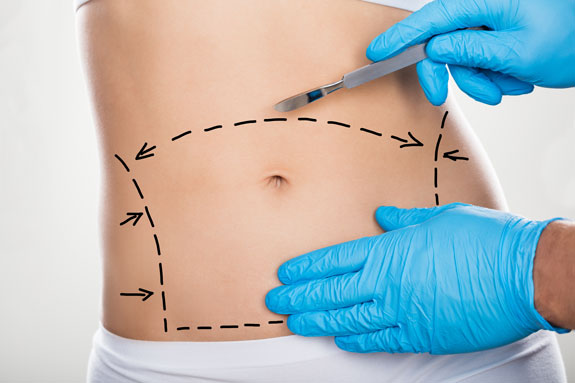 Abdominoplastik Ebersberg